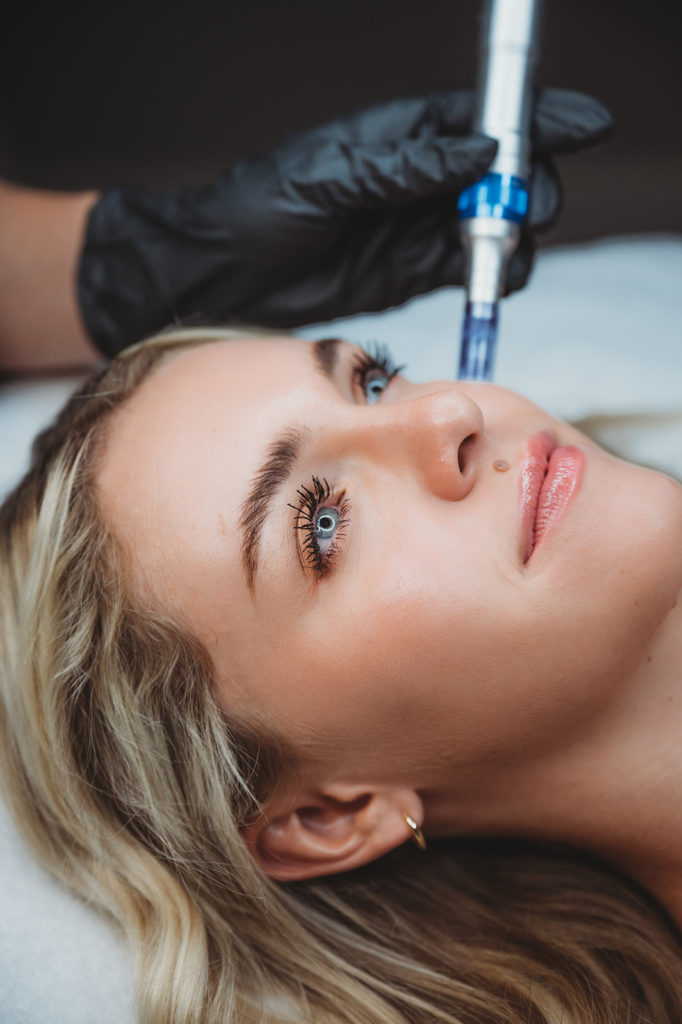 Microneedling in Alpine, Utah | Glo Esthetics