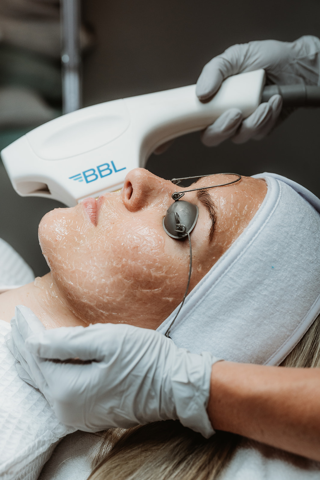 Glo BBL in Alpine, UT | Glo Esthetics