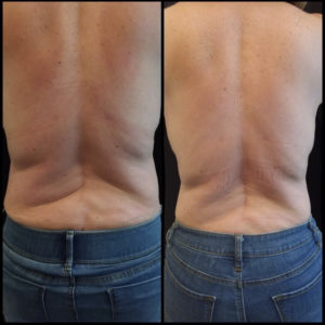 Before and After Coolsculpting Treatment Photos | Glo Esthetics in Alpine, UT