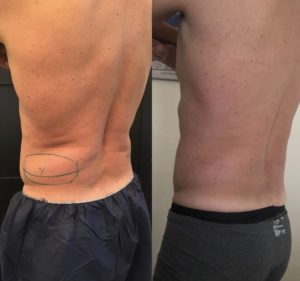 Before and After Coolsculpting Photos | Glo Esthetics in Alpine, UT