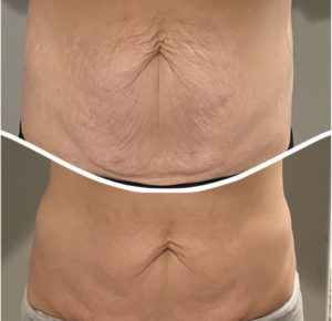 Before and After Coolsculpting Photos | Glo Esthetics in Alpine, UT