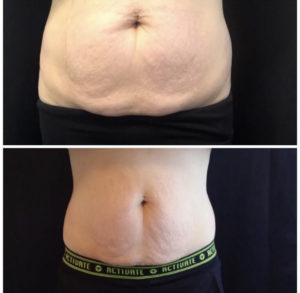 Before and After Coolsculpting Photos | Glo Esthetics in Alpine, UT