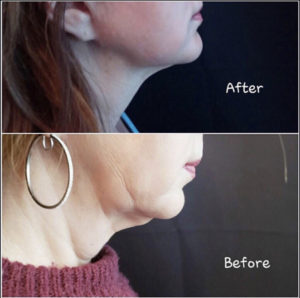 Before and After Chin Coolsculpting Photos | Glo Esthetics in Alpine, UT