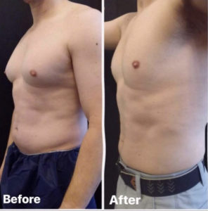 Before and After Coolsculpting For Men Photos | Glo Esthetics in Alpine, UT