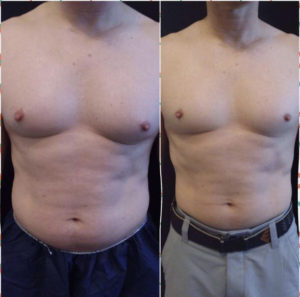 Before and After Coolsculpting For Men Photos | Glo Esthetics in Alpine, UT