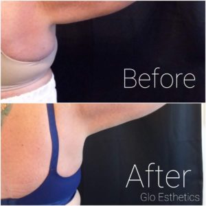 Before and After Coolsculpting Shoulder Treatment Photos | Glo Esthetics in Alpine, UT