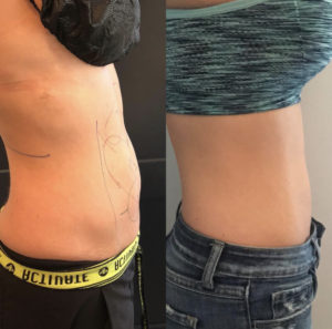 Before and After Coolsculpting Treatment Photos | Glo Esthetics in Alpine, UT