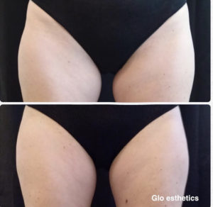 Before and After Coolsculpting Thigh Treatment Photos | Glo Esthetics in Alpine, UT