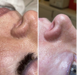 Before and After Facial Treatment Photos | Glo Esthetics in Alpine, UT