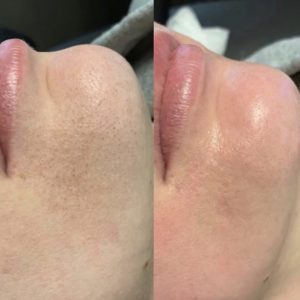 Before and After Facial Treatment Photos | Glo Esthetics in Alpine, UT