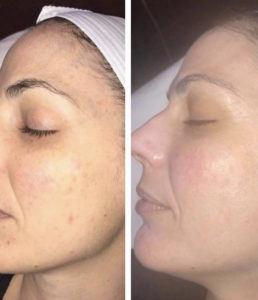 Before and After Facial Treatment Photos | Glo Esthetics in Alpine, UT