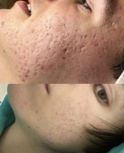 Before and After Facial Treatment Photos | Glo Esthetics in Alpine, UT