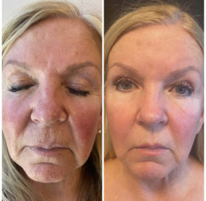 Before and After Facial Treatment Photos | Glo Esthetics in Alpine, UT