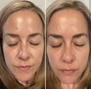 Before and After Facial Treatment Photos | Glo Esthetics in Alpine, UT