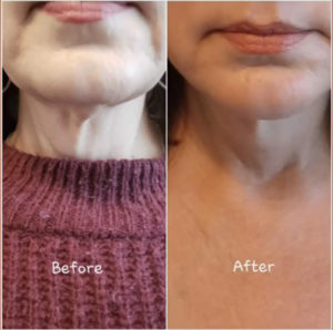 Before and After Neck Facial Treatment Photos | Glo Esthetics in Alpine, UT