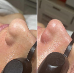 Before and After Facial Treatment Photos | Glo Esthetics in Alpine, UT