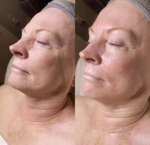 Before and After Facial Treatment Photos | Glo Esthetics in Alpine, UT