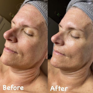 Before and After Facial Treatment Photos | Glo Esthetics in Alpine, UT