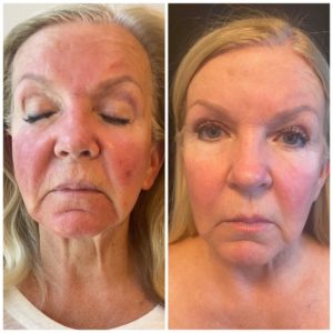 Before and After BBL Treatment Photos | Glo Esthetics in Alpine, UT