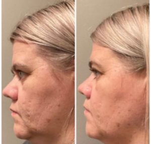Before and After BBL Treatment Photos | Glo Esthetics in Alpine, UT