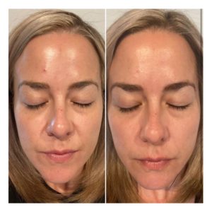 Before and After BBL Treatment Photos | Glo Esthetics in Alpine, UT