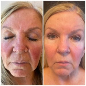 Before and After BBL Treatment Photos | Glo Esthetics in Alpine, UT