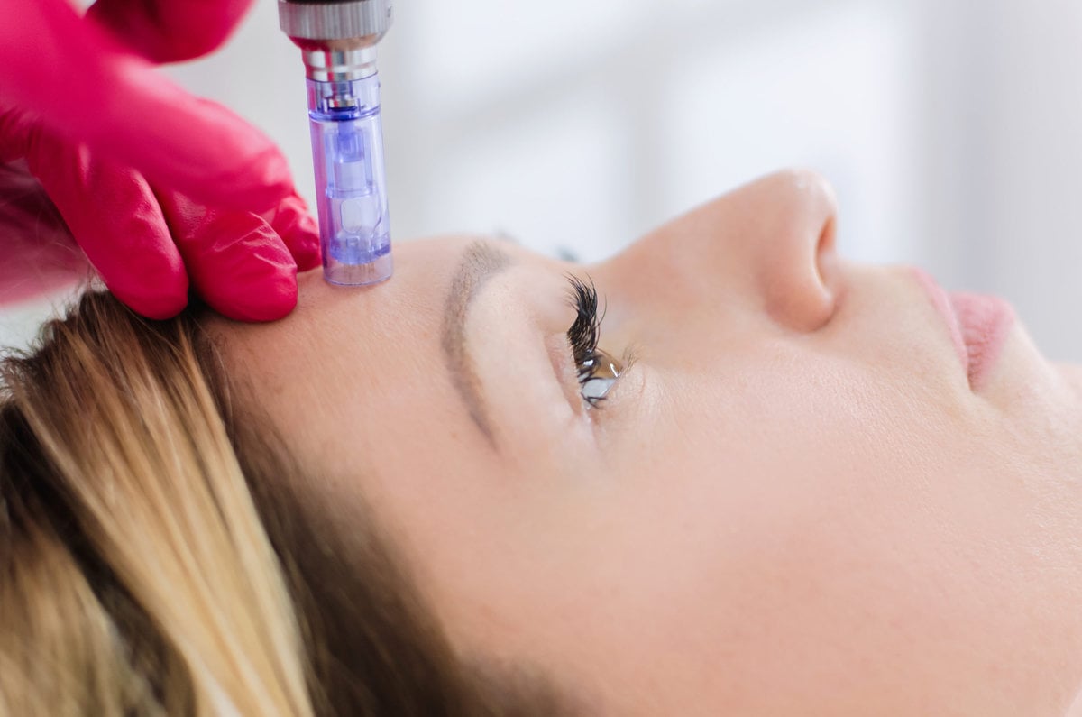 Microneedling Benefits and Results