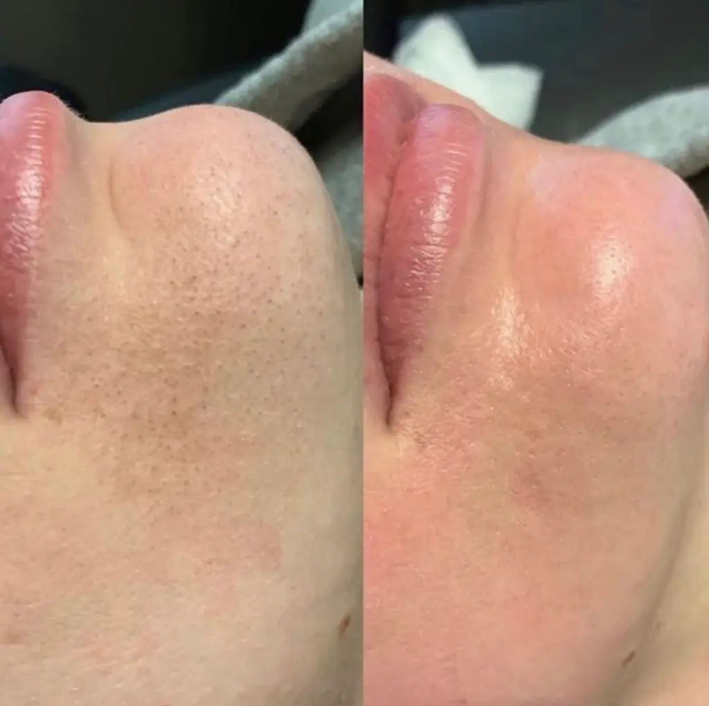 glo aestheic before & after