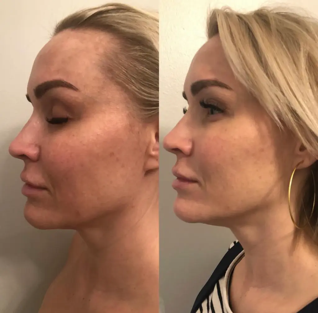 glo aestheic before & after