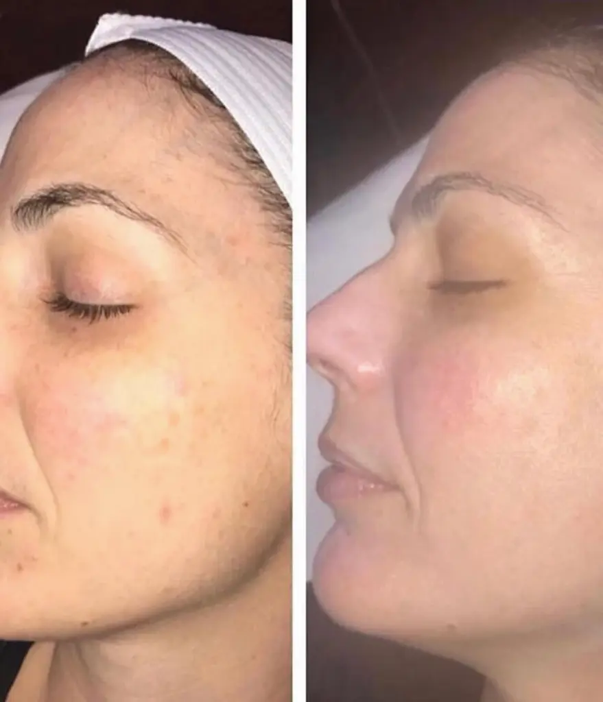 glo aestheic before & after