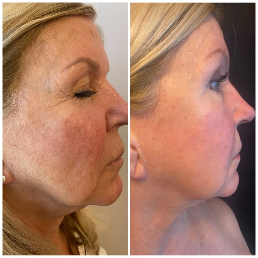 glo aestheic before & after