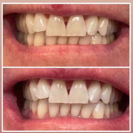 Teeth Whitening1
