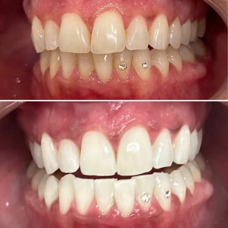 gloesthetics-teethwhitening